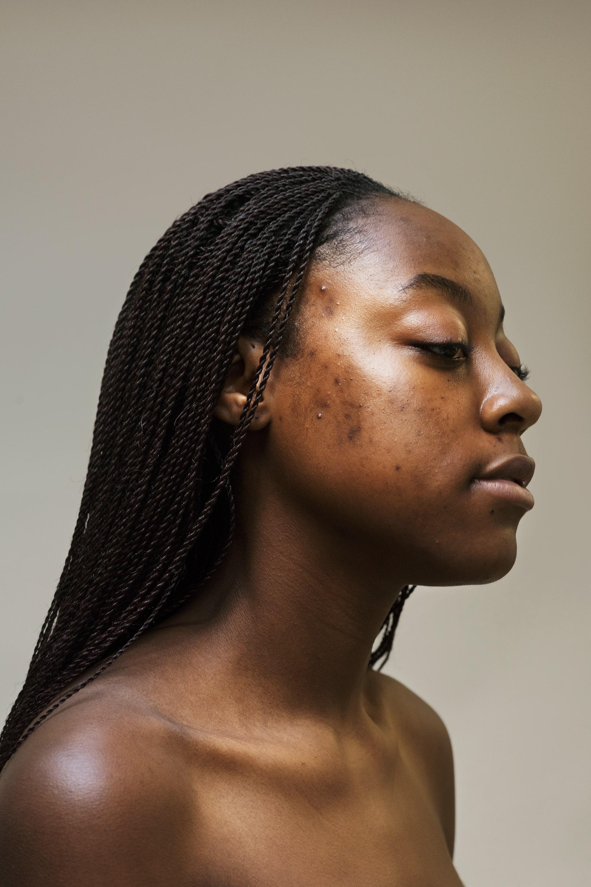 Has The Acne-Positivity Movement Actually Got Us Anywhere ...